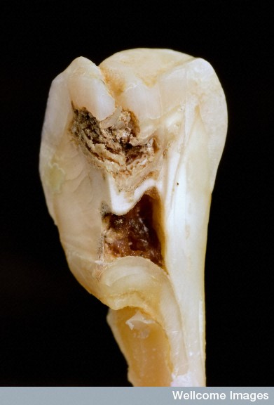 Tooth Worms  Effaced From History?