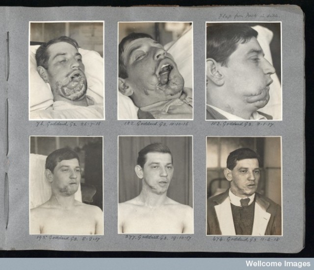 L0044680 Album of photographs of plastic surgery cases